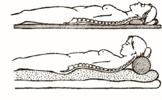 Osteochondrozės figūra